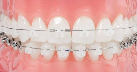 A ceramic fixed braces