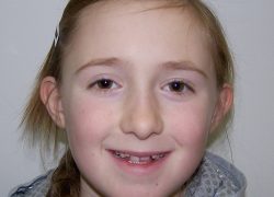 Young patient requiring orthodontic treatment at Smile101