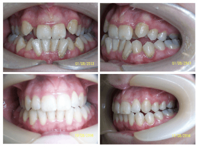 Before and after shots of a patients teeth