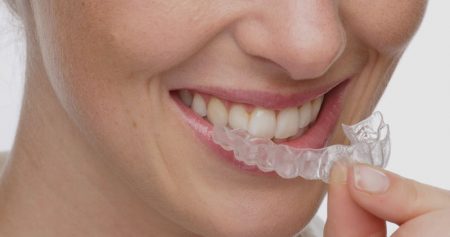 Inviaslign removable braces