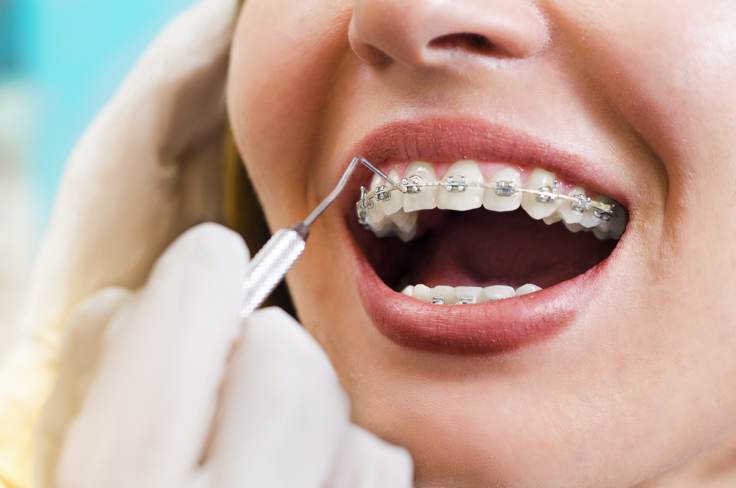 10 Questions you need to ask before choosing an orthodontist