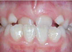 Young patient requiring orthodontic treatment at Smile101