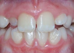 Young patient requiring orthodontic treatment at Smile101
