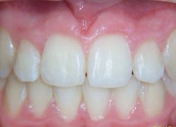 Young patient requiring orthodontic treatment at Smile101