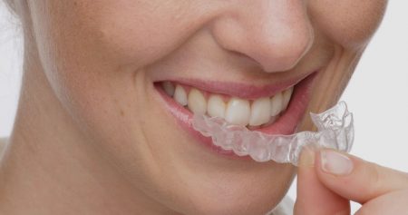 Inviaslign removable braces
